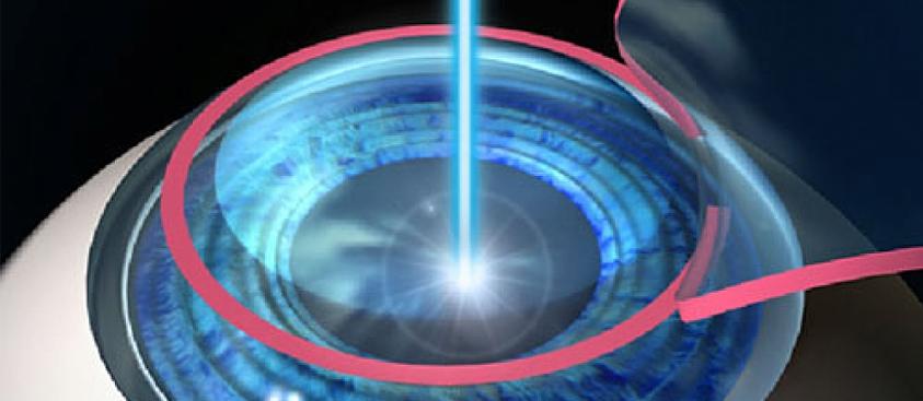 Cirurgia Refrativa Laser